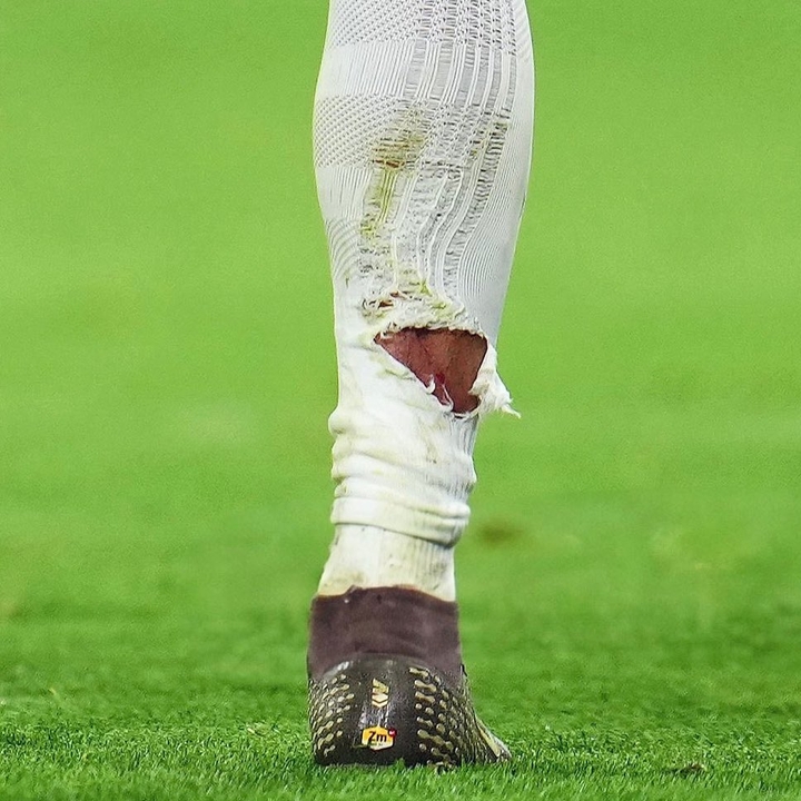 开云官网-有点狠！塔蹬踏姆巴佩小腿染黄，姆巴佩小腿袜被踩破露出血痕